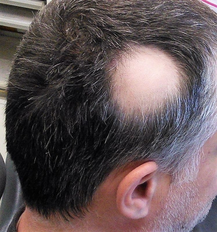 Alopecia_areata