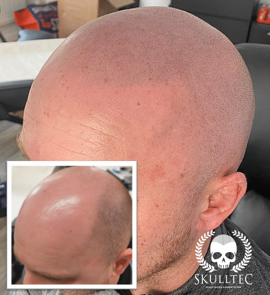 scalp micropigmentation