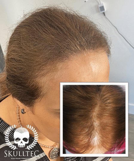 Scalp micropigmentation