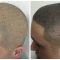 Scalp Micropigmentation For Thinning Hair