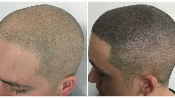 Scalp Micropigmentation For Thinning Hair