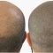 Micropigmentation For Hair | Micro Hair Pigmentation