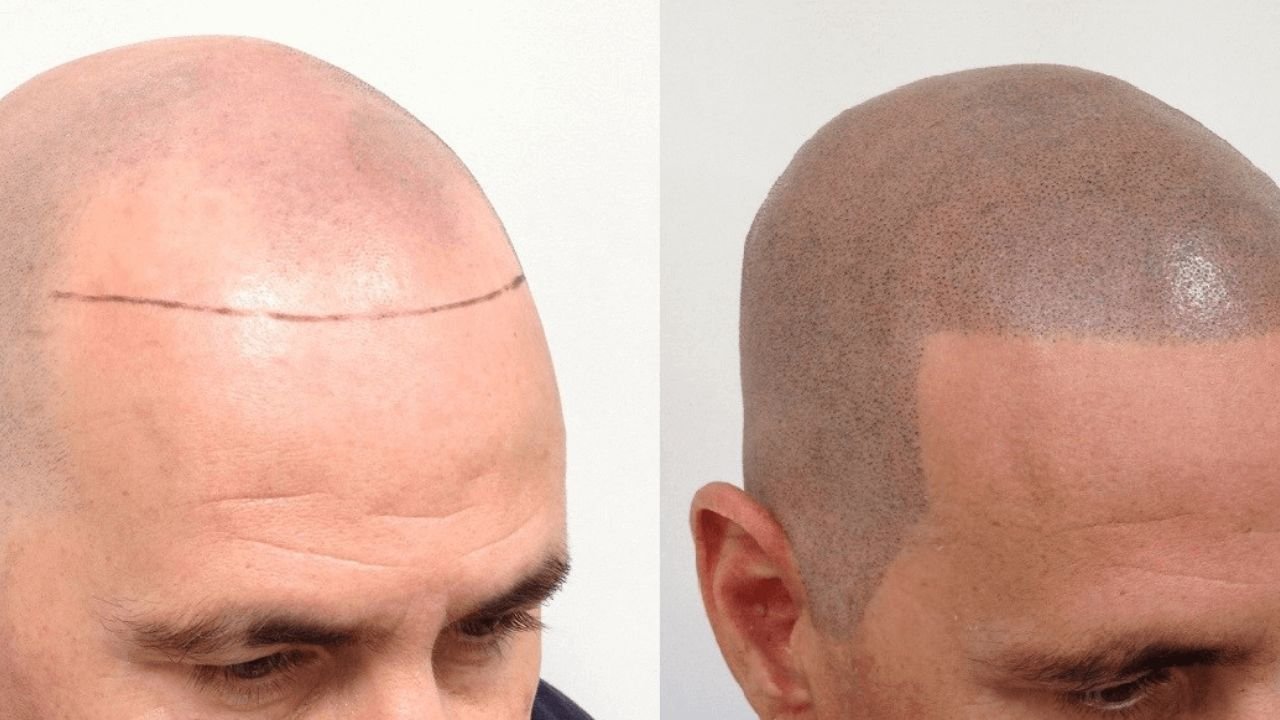 Navigating Scalp Micropigmentation Regrets: Expert Advice