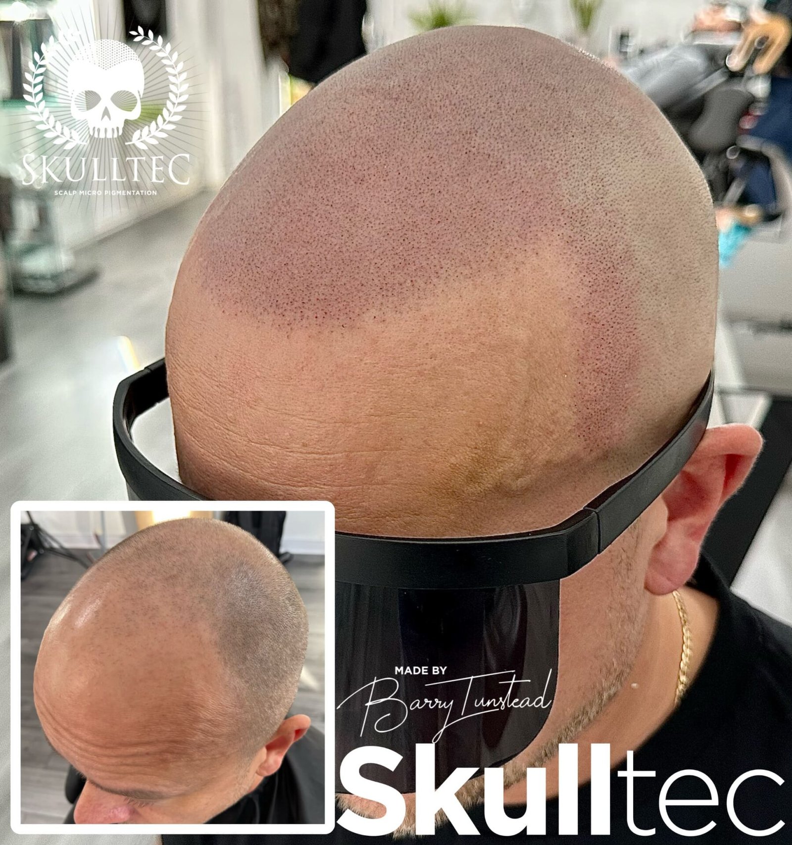 Scalp Micropigmentation