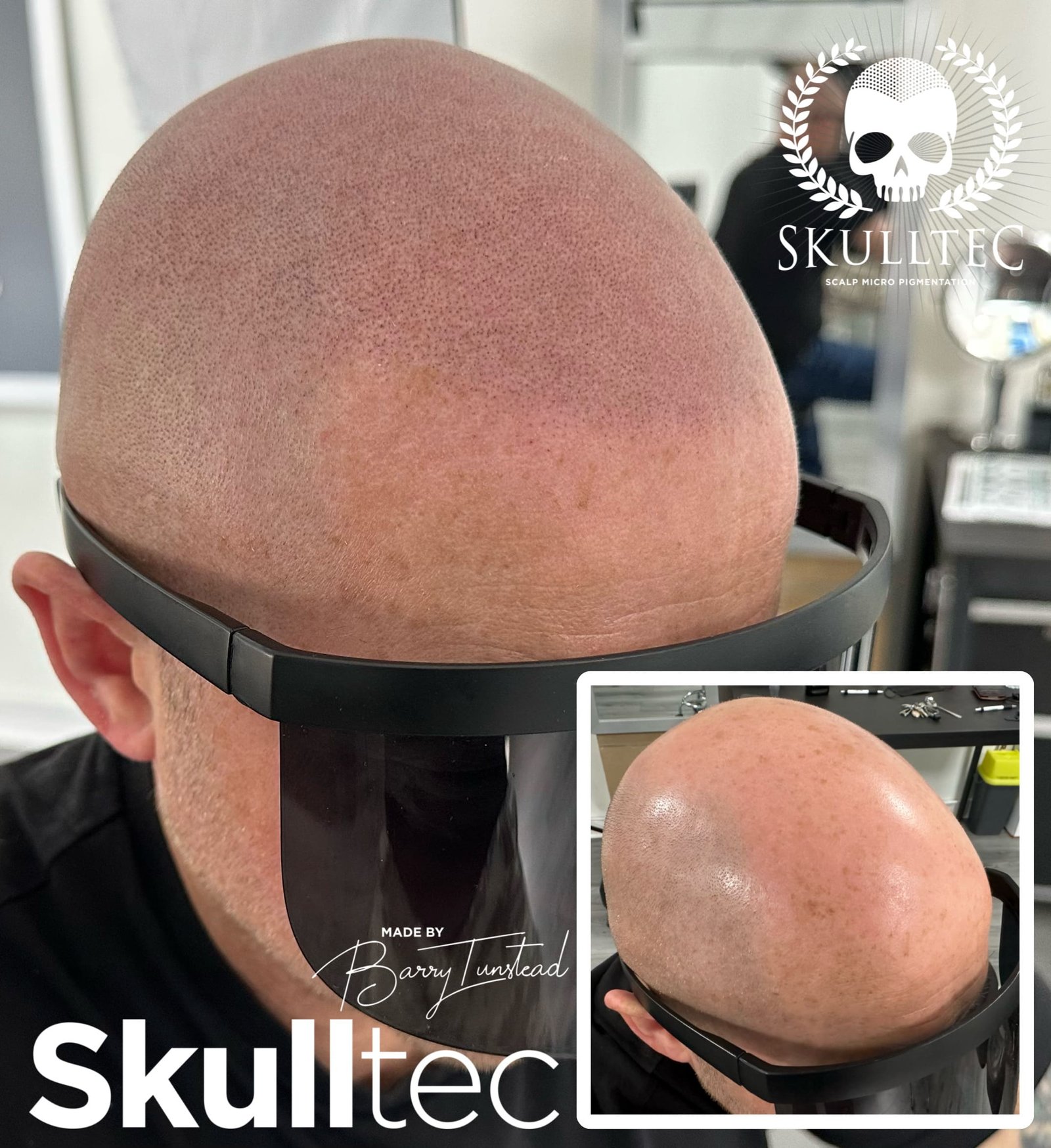 Scalp Micropigmentation