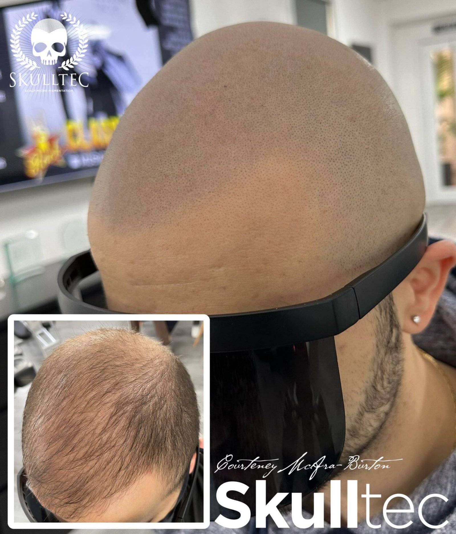 Scalp Micropigmentation