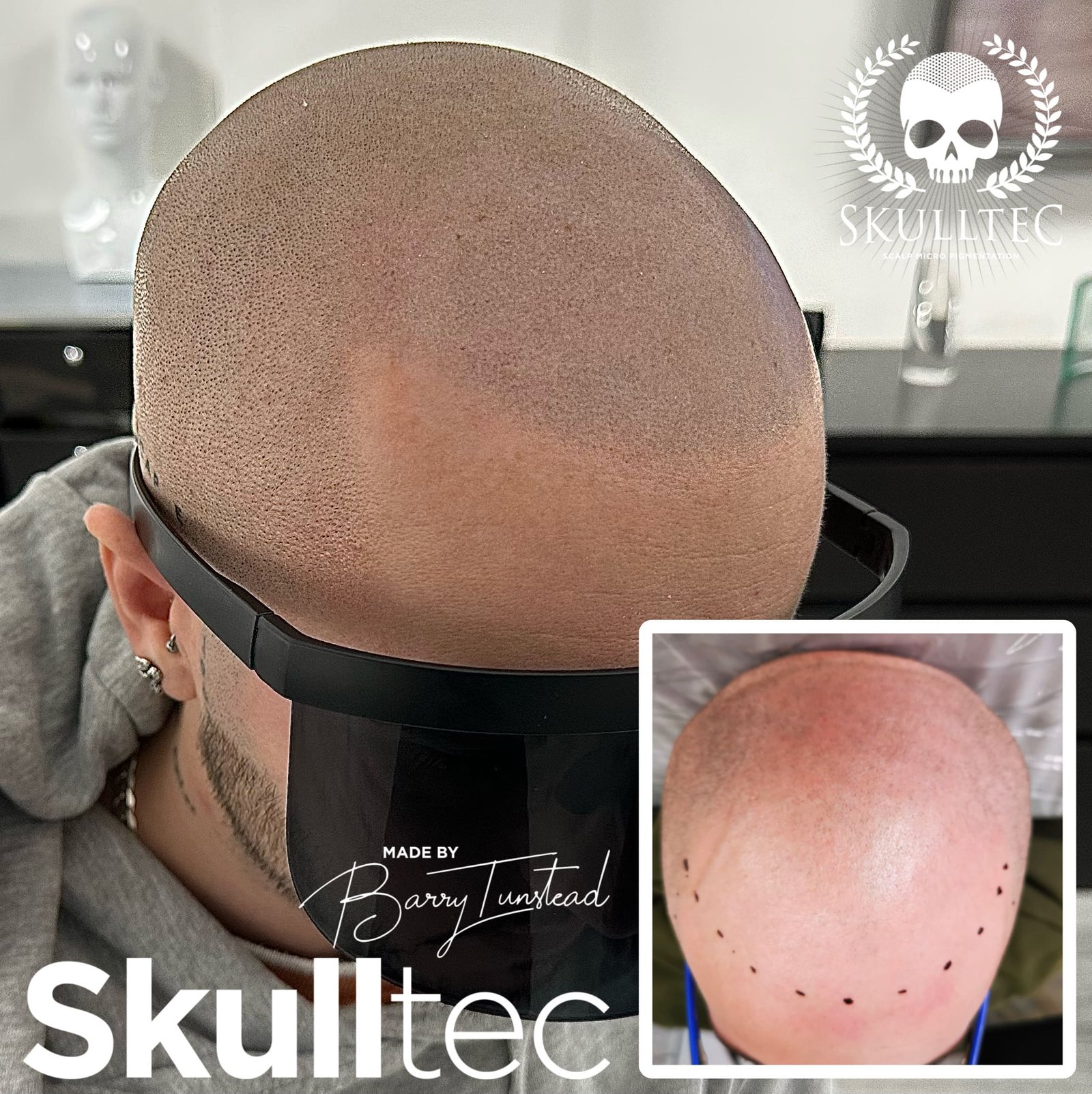 Scalp Micropigmentation