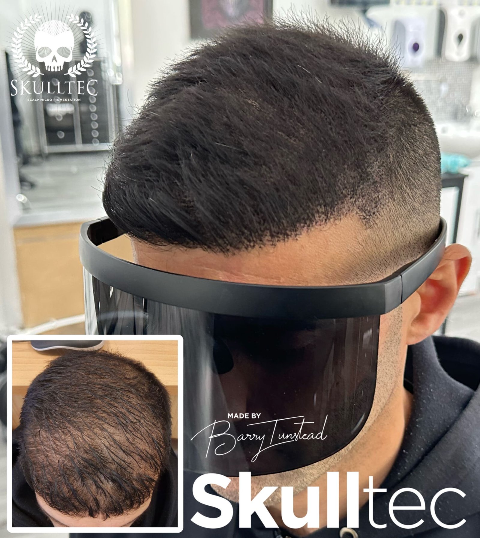 Scalp Micropigmentation