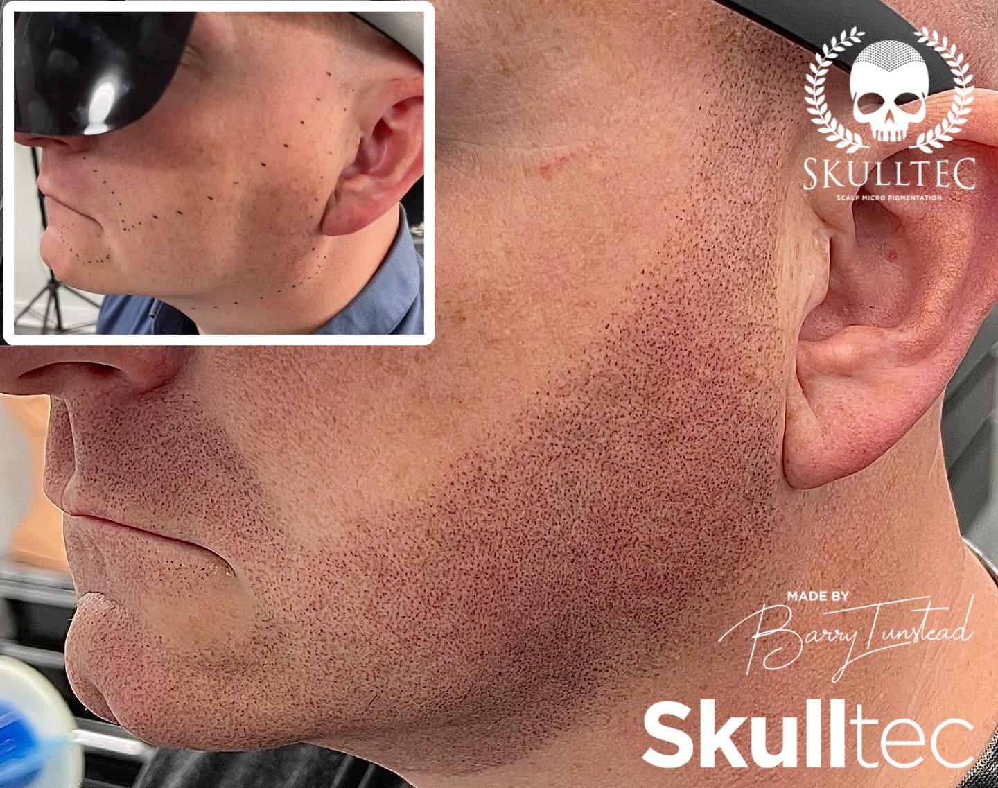 Scalp Micropigmentation