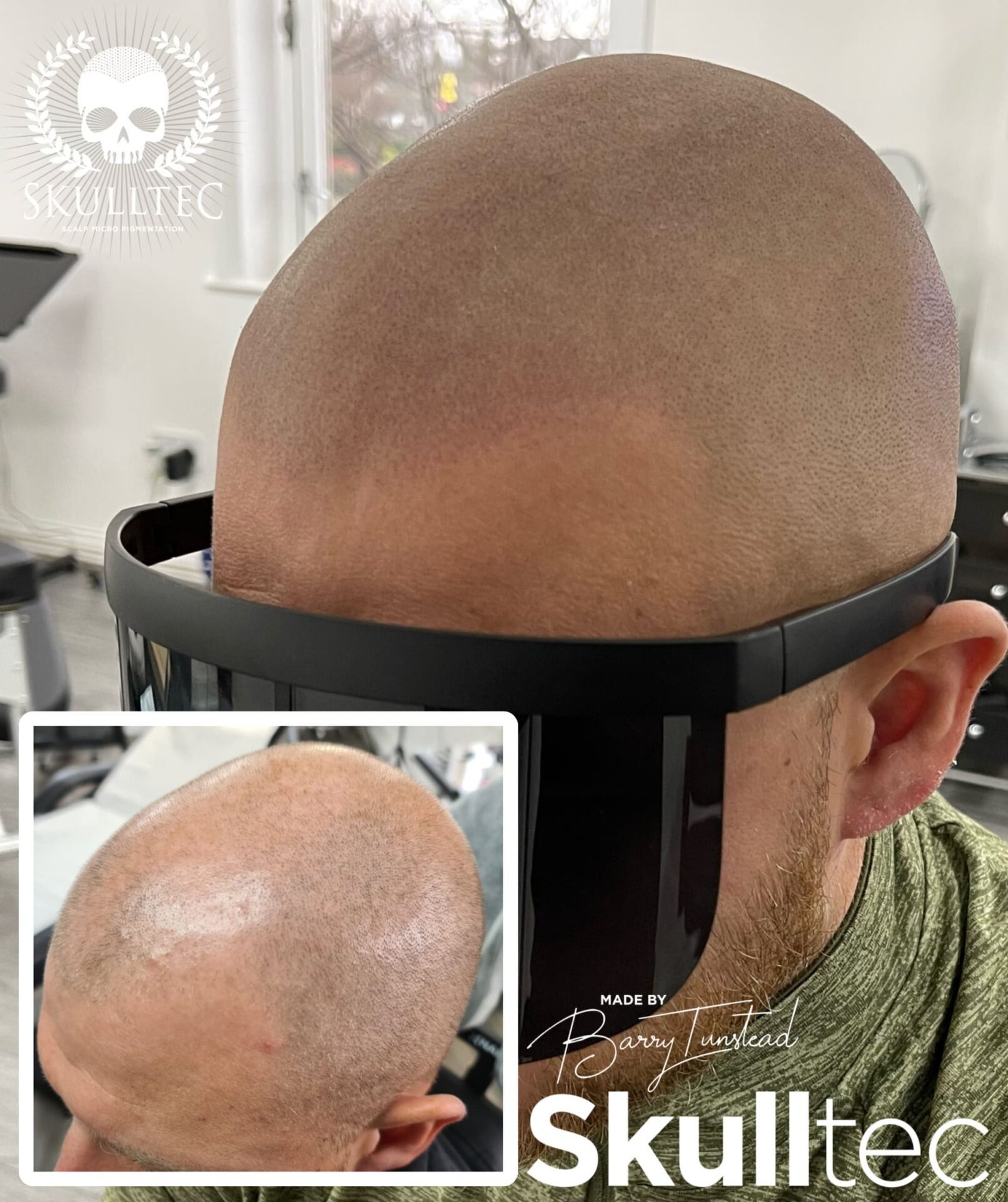 Scalp Micropigmentation