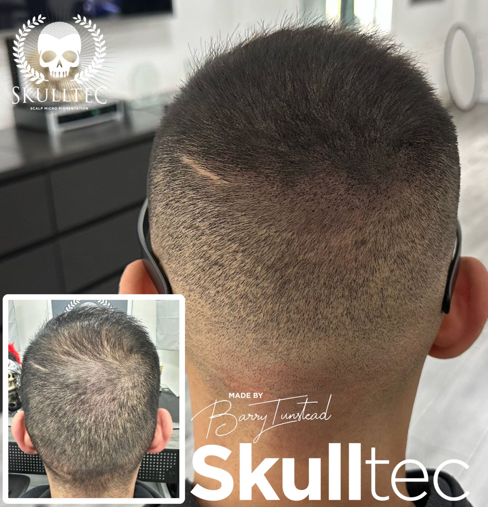 Scalp Micropigmentation