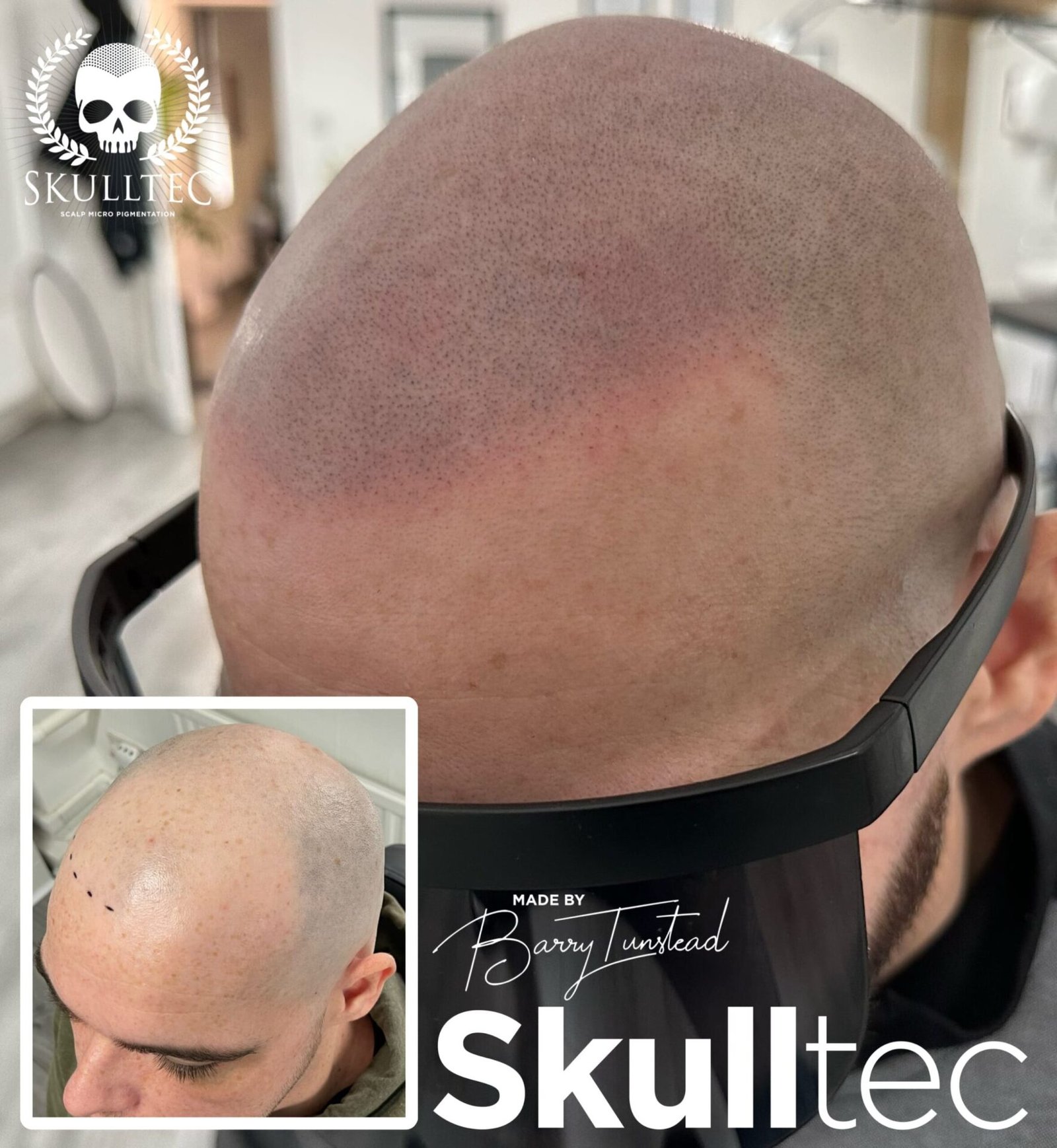 Scalp Micropigmentation