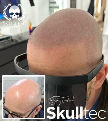 Scalp Micropigmentation