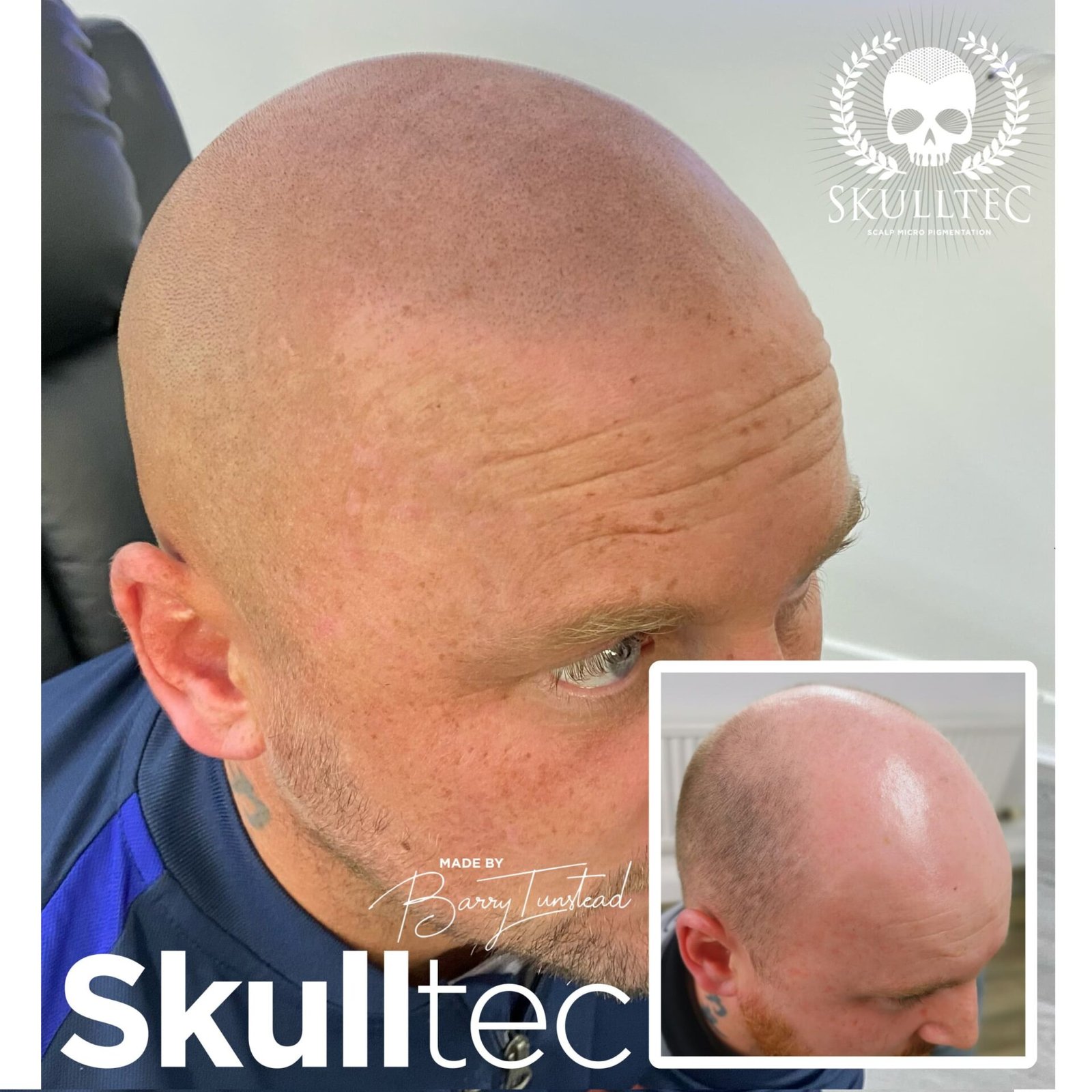 Scalp Micropigmentation