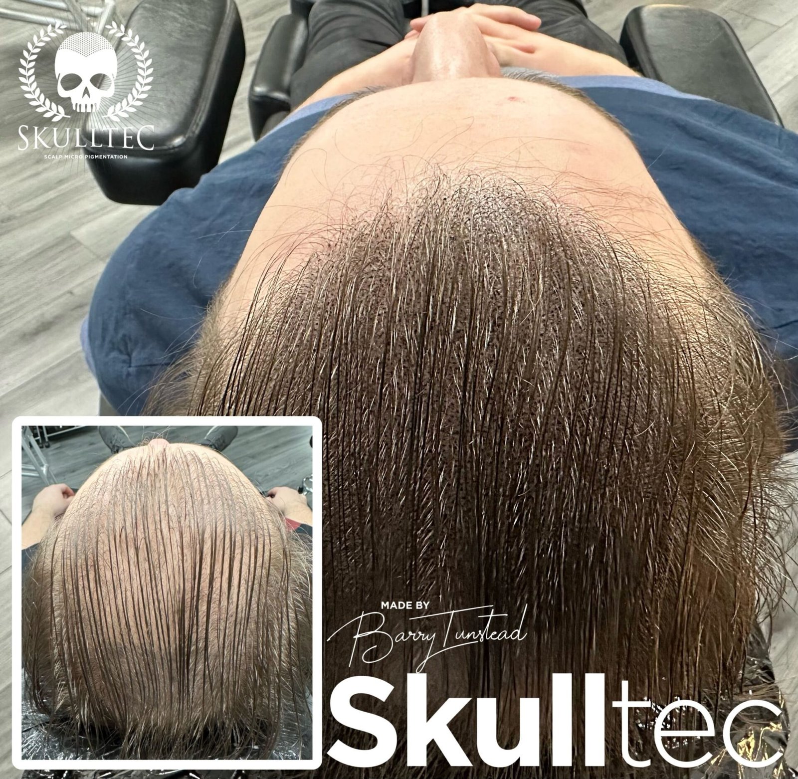 scalp micropigmentation for long hair