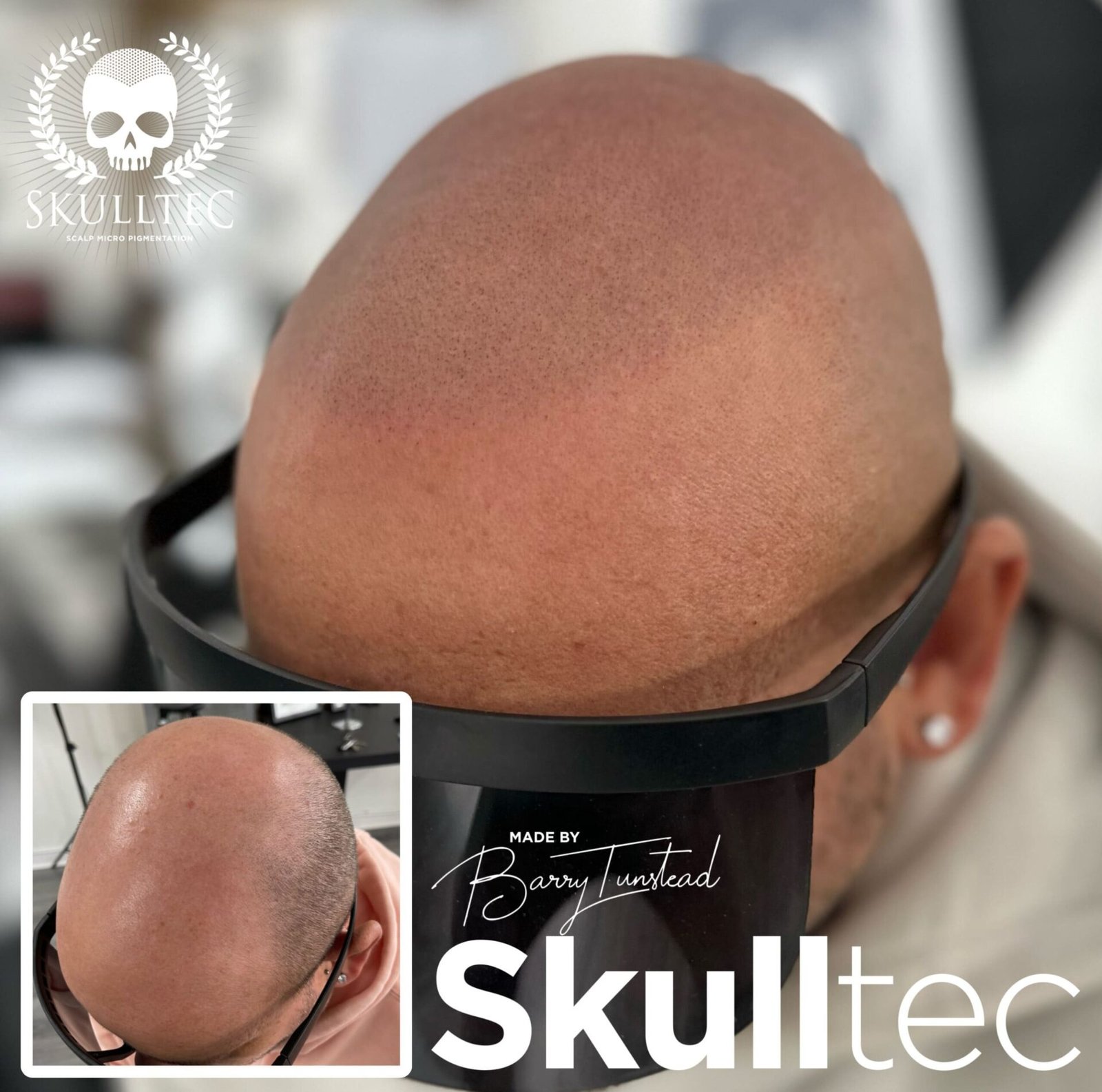 Scalp Micropigmentation