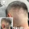 Is Scar Camouflage with SMP an Invasive Procedure?