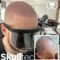 What Is the Recovery Time After Scalp Micropigmentation London?