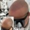 How Can I Find Affordable Hair Scalp Micropigmentation Cost Without Compromising Quality?