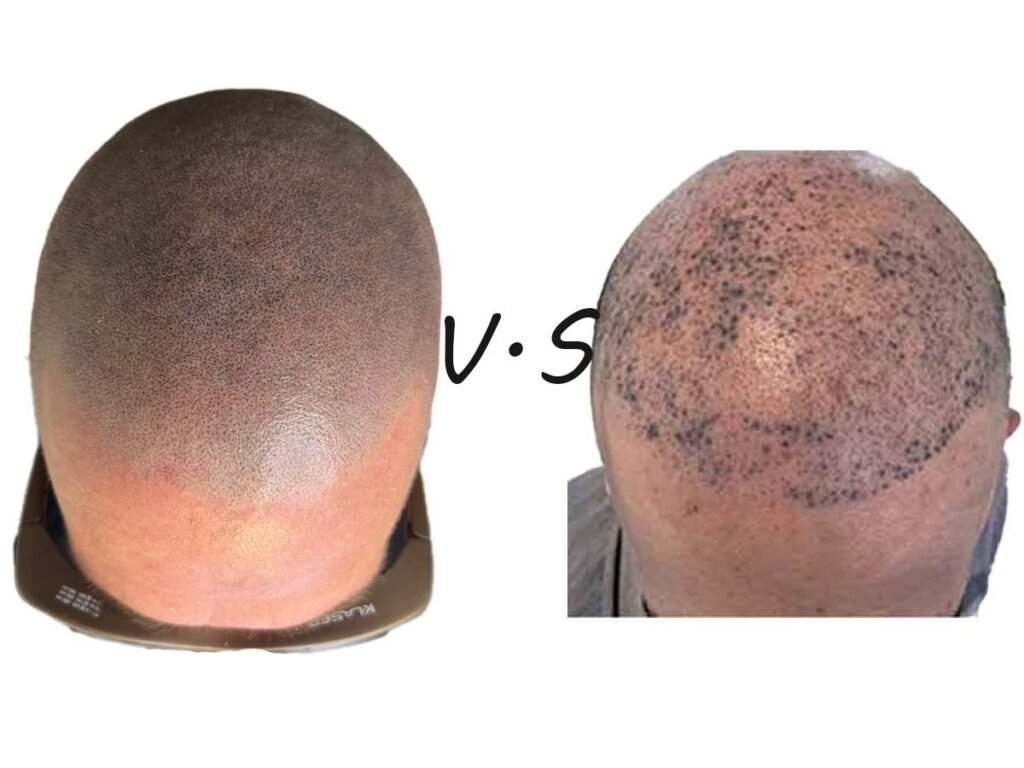 Scalp Micropigmentation Regrets